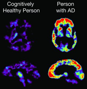 PET Scan showing PiB uptake - Image courtesy of the National Institute on Aging/National Institutes of Health